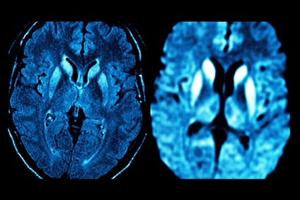 CREUTZFELDT JAKOB DISEASE, MRI