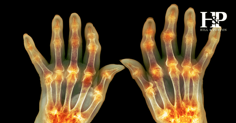 VA Rating for Rheumatoid Arthritis